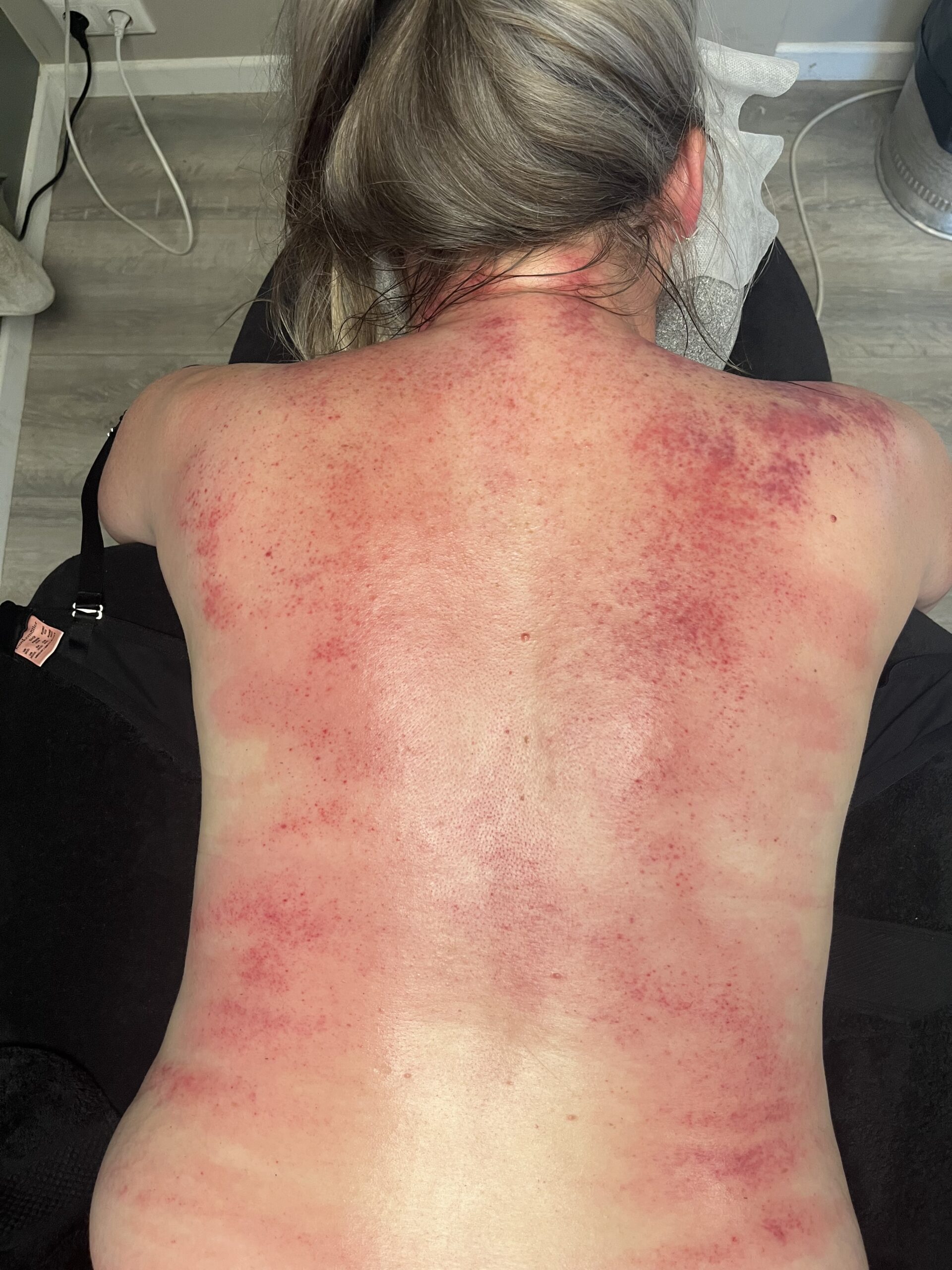 Guasha behandeling schrapen cupping spanning loslaten 